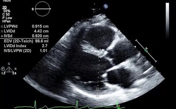 2D Echo Test