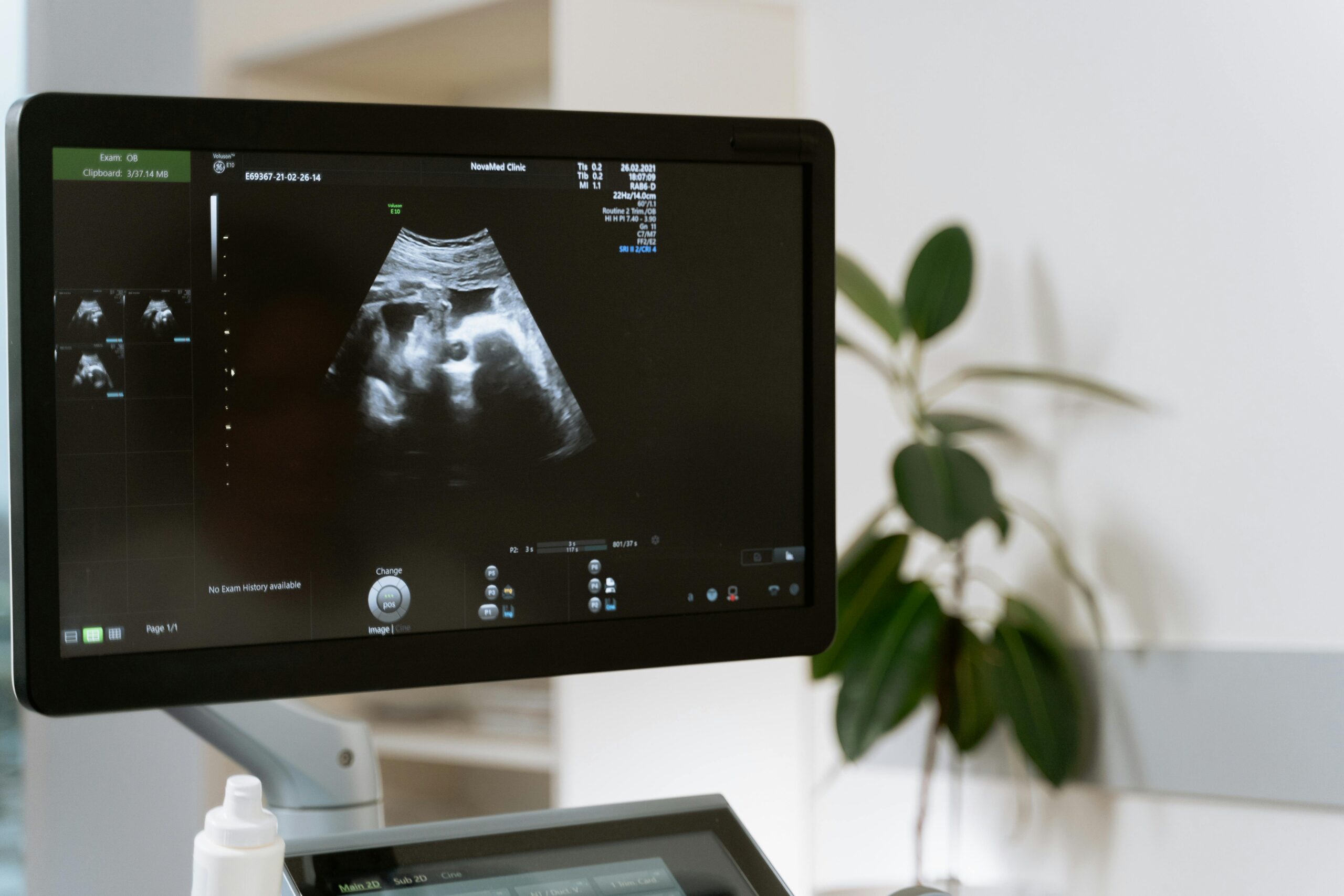 Medical ultrasound scan showing a fetus on a monitor in a clinic setting.